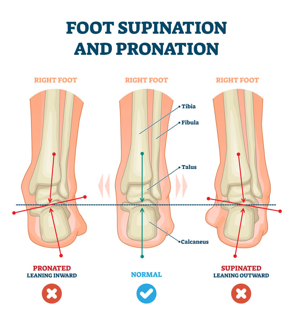 Are you ‘out of step’? Understanding over pronation and its impact on your body image